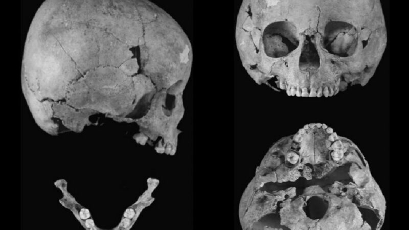 Najstariji potvrđeni slučaj Daunovog sindroma, od pre 1.500 godina