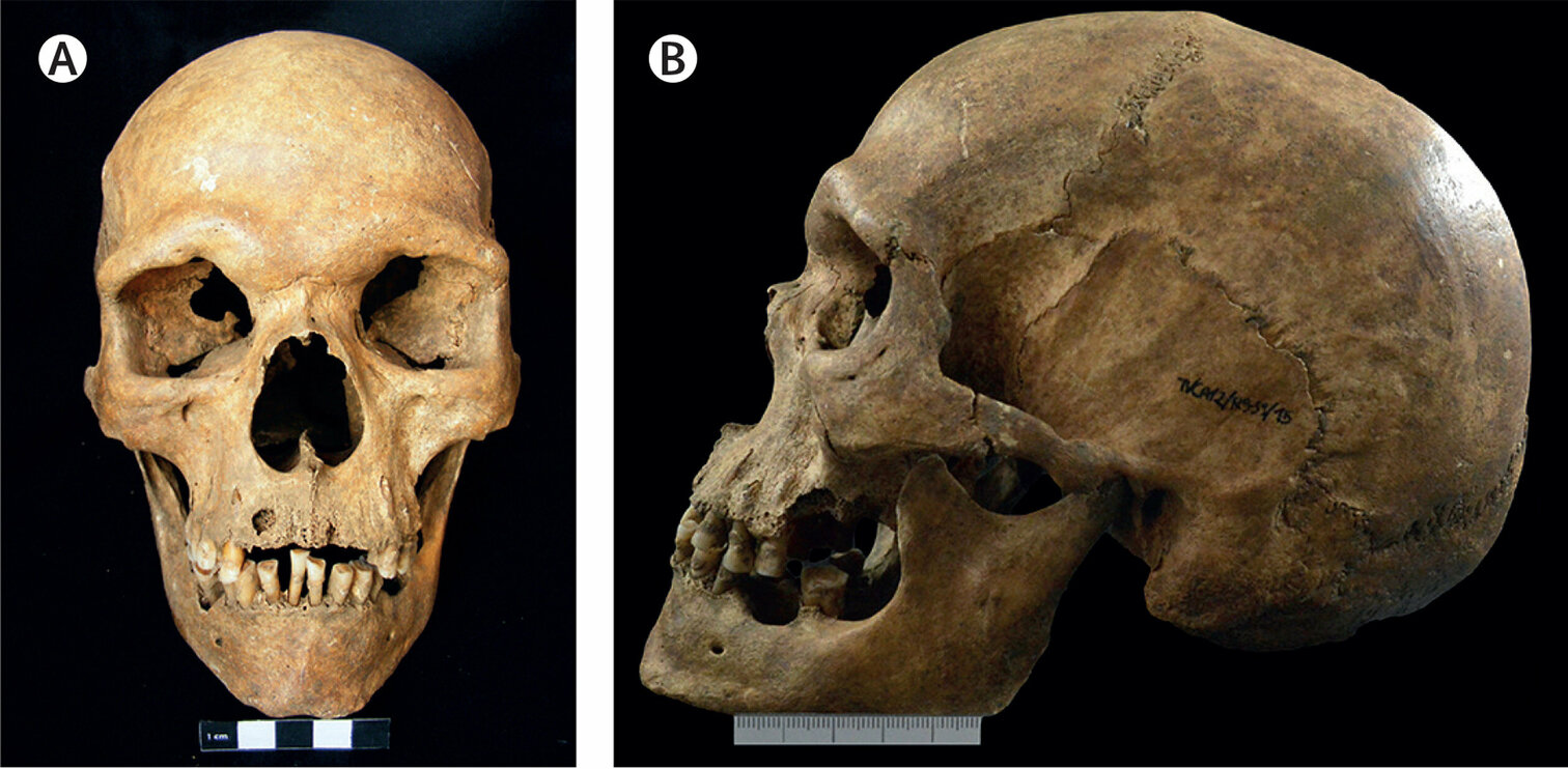 Otkriven je najstariji slučaj Klinefelterovog sindroma na skeletu starom 1000 godina
