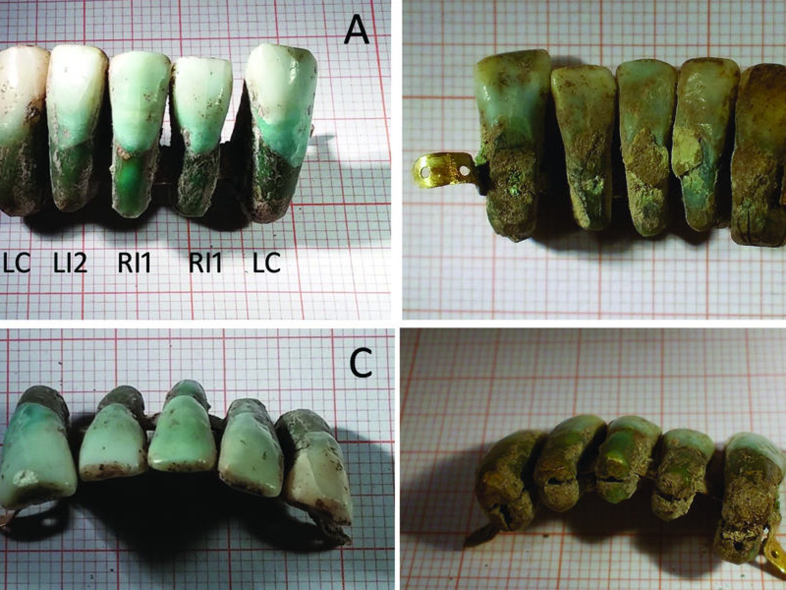 Proteza napravljena od ljudskih zuba pronađena u Toskani
