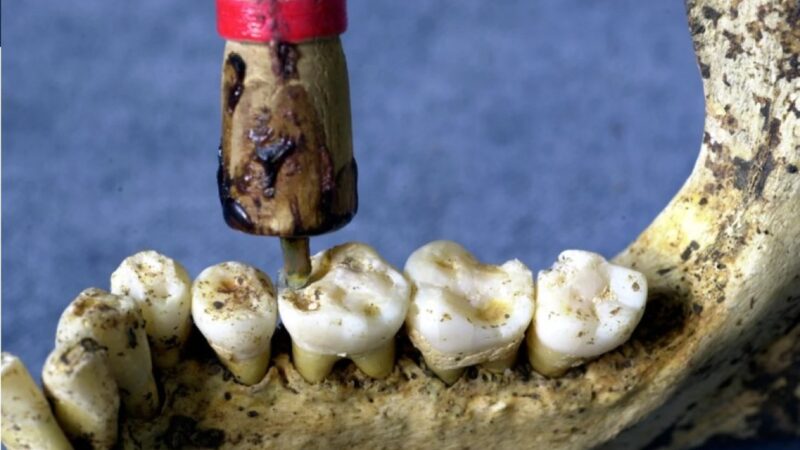 Najstariji dokazi upotrebe plombi na zubima