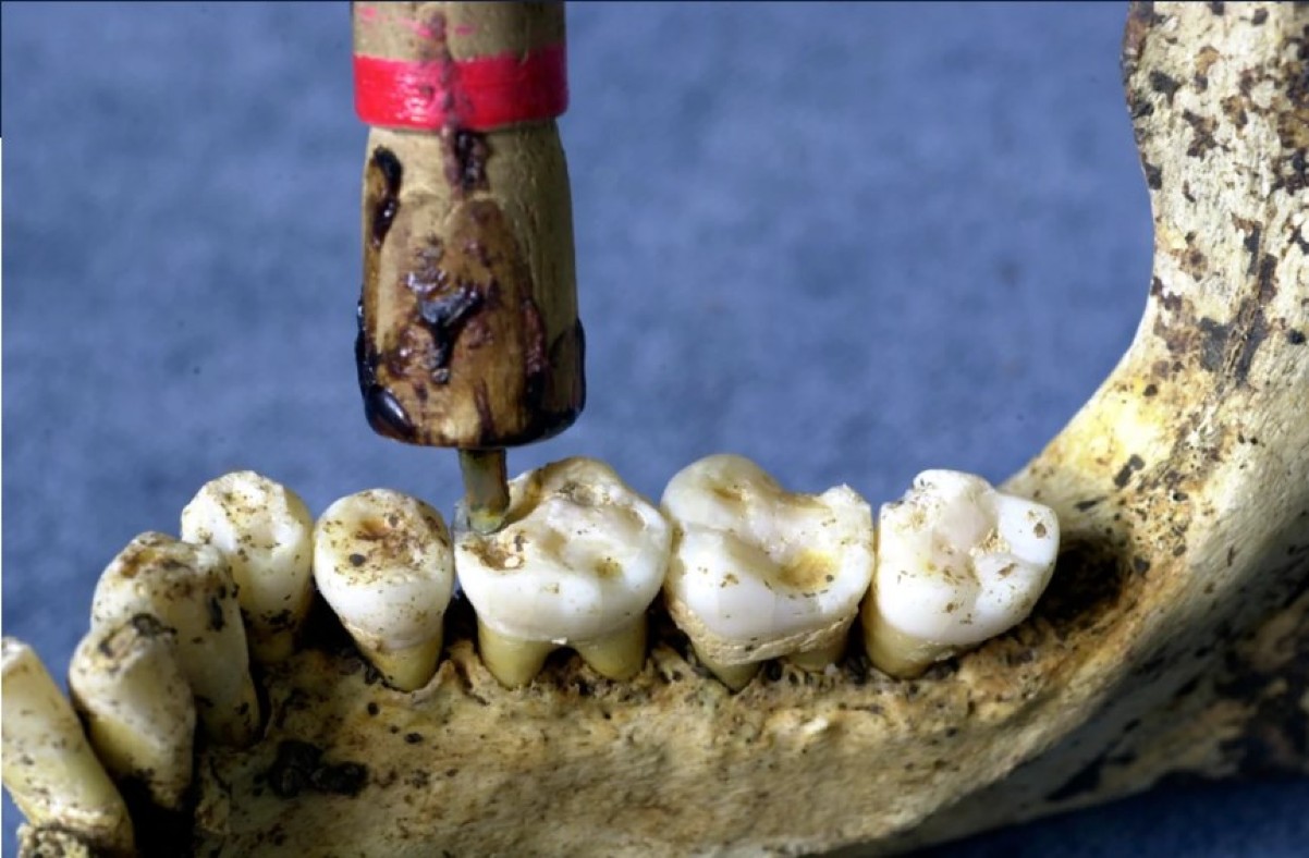 Najstariji dokazi upotrebe plombi na zubima