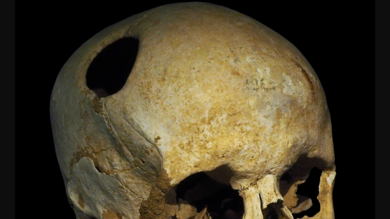 Najstariji tragovi trepanacije pronađeni u Čatalhujuku