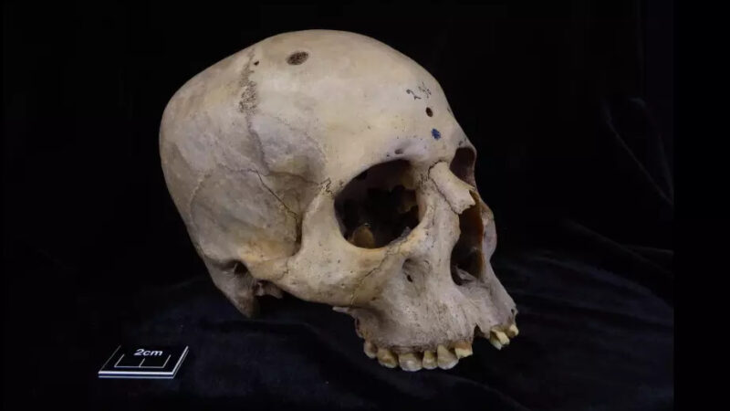 Pre 4.000 godina stari Egipćani su pokušali da izleče rak na glavi