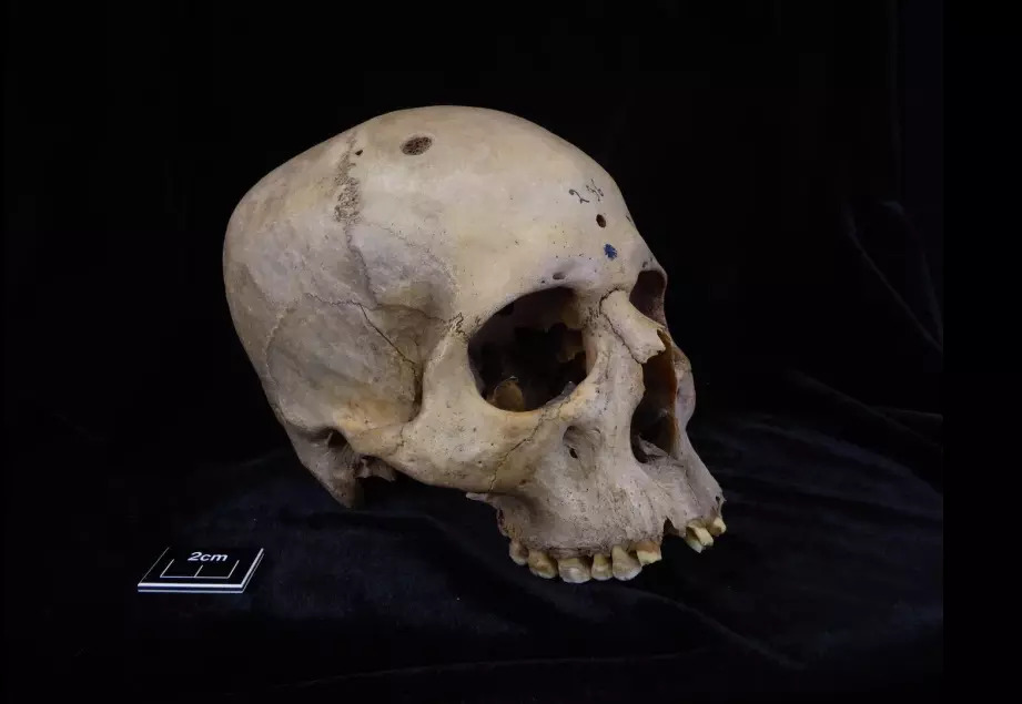 Pre 4.000 godina stari Egipćani su pokušali da izleče rak na glavi