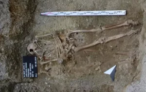 Prostetička šaka na levoj ruci kod pokojnika u grobu
