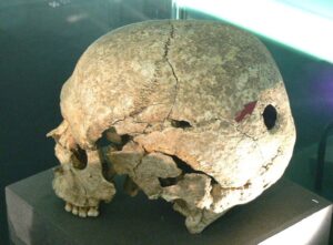 Trepanacija